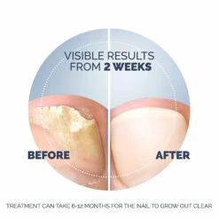 Scholl Kalknagel Behandelset -Winkel Voor Gezondheidszorgproducten 1053908 6